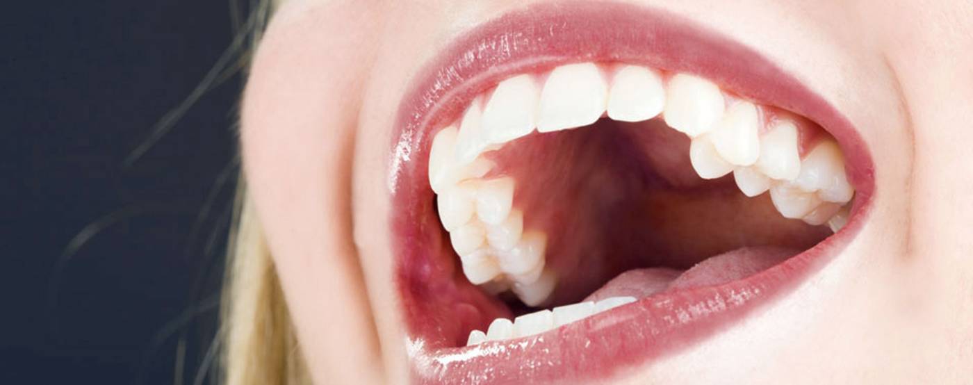 studio-dentistico-ballestrasse-besana-brianza-intarsi-estetici