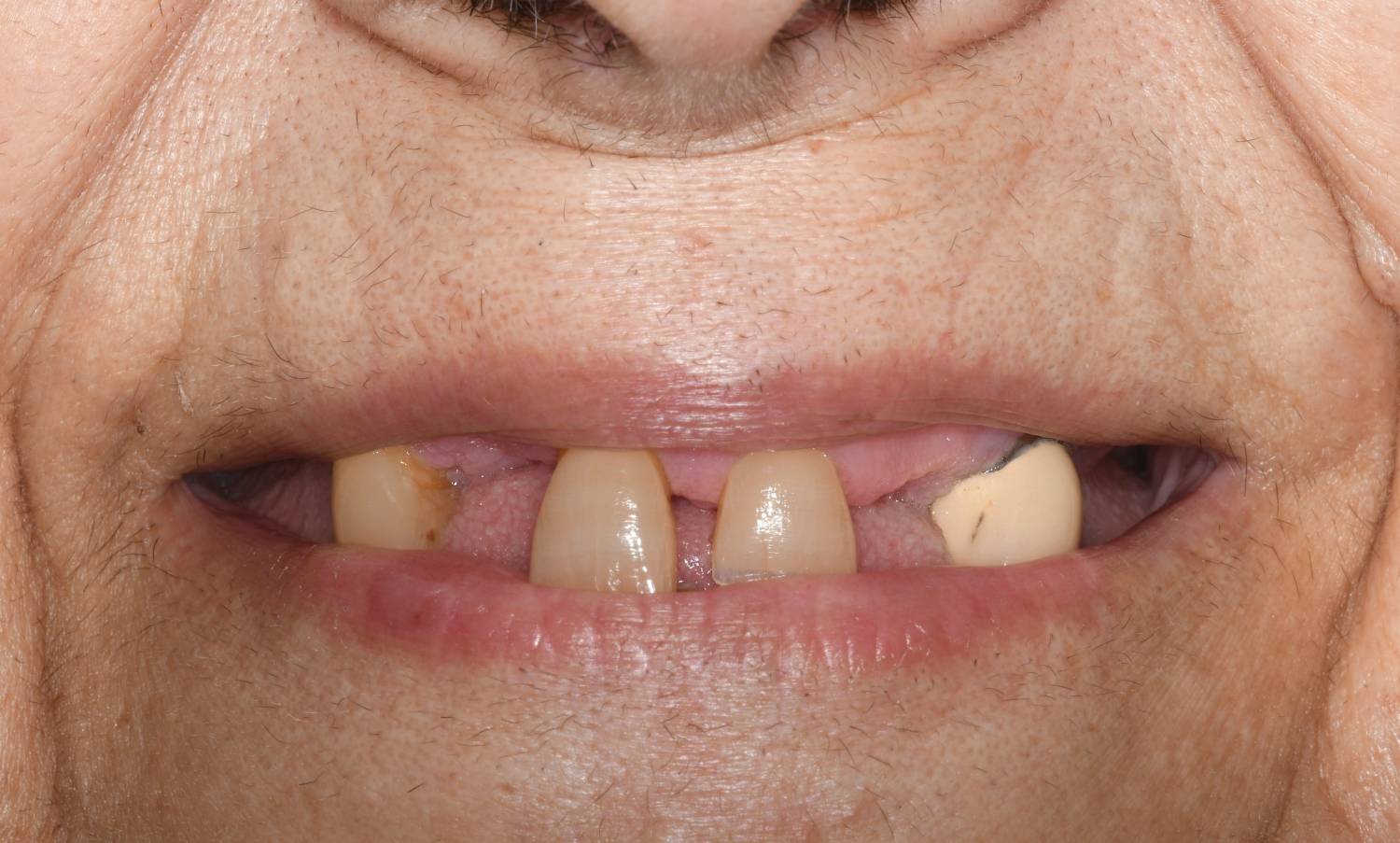 Quando si dice quattro denti messi in croce | Dentista Dott. Fabio ...