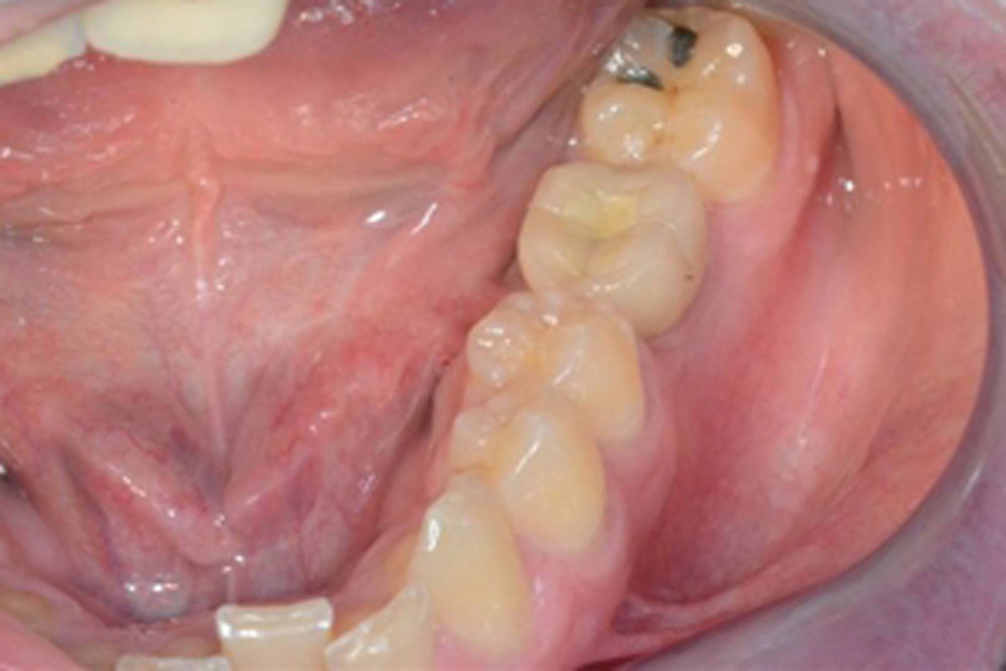 studio-dentistico-ballestrasse-besana-brianza-caso-clinico-7.4