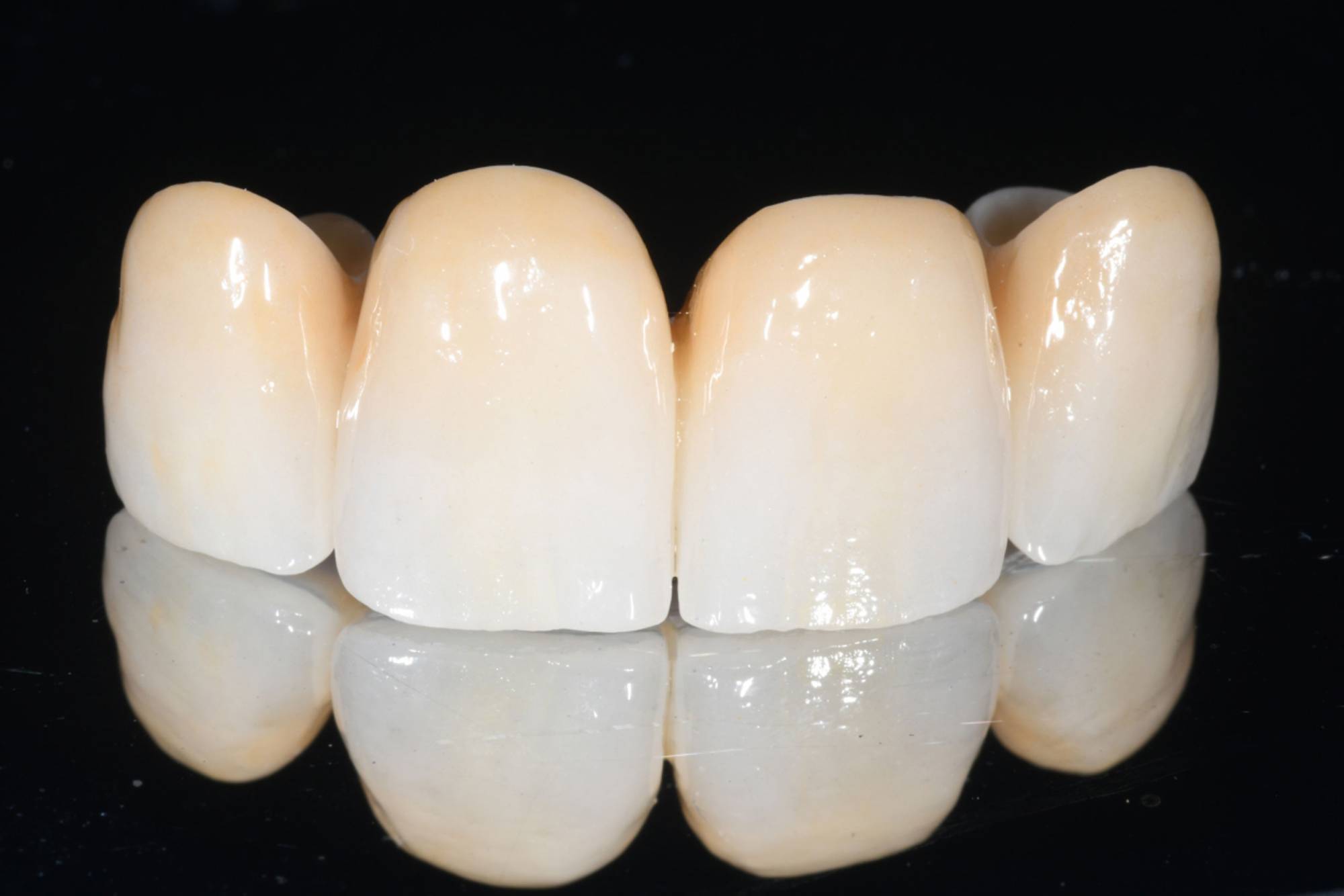 studio-dentistico-ballestrasse-besana-brianza-caso-clinico-46.3