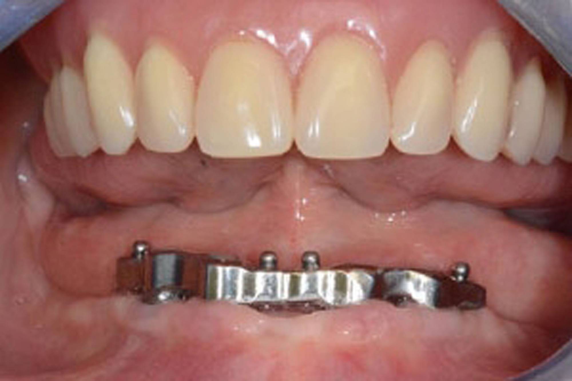 studio-dentistico-ballestrasse-besana-brianza-caso-clinico-12.2