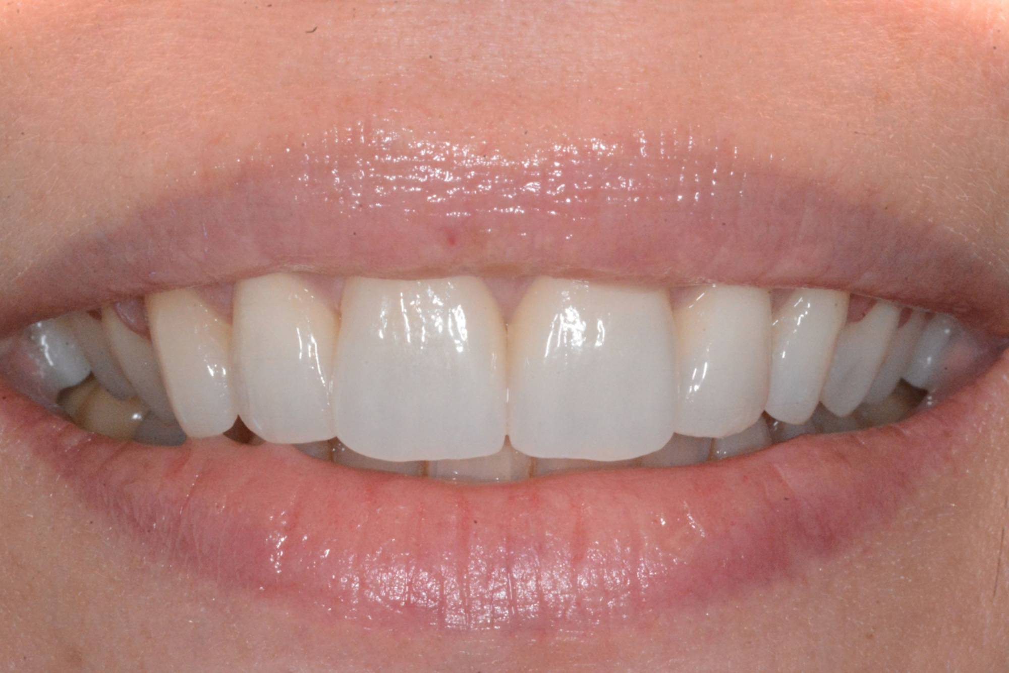 studio-dentistico-ballestrasse-besana-brianza-caso-clinico-35.4