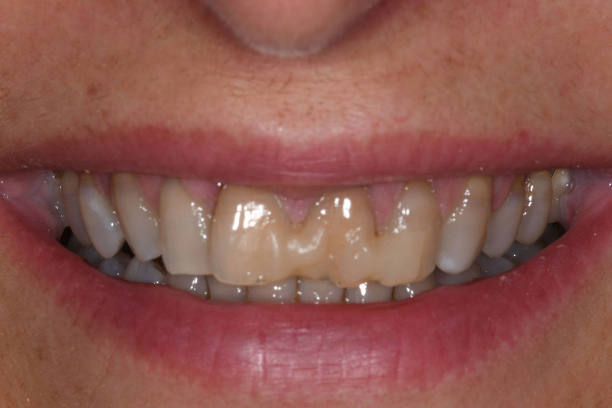 studio-dentistico-ballestrasse-besana-brianza-caso-clinico-47.1