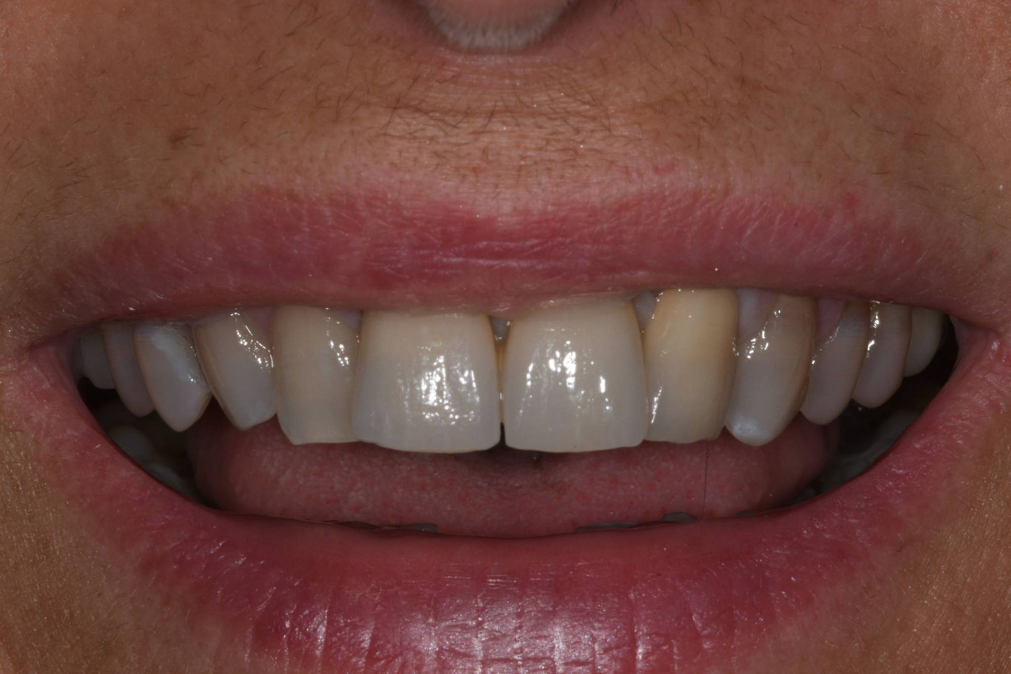 studio-dentistico-ballestrasse-besana-brianza-caso-clinico-47.2