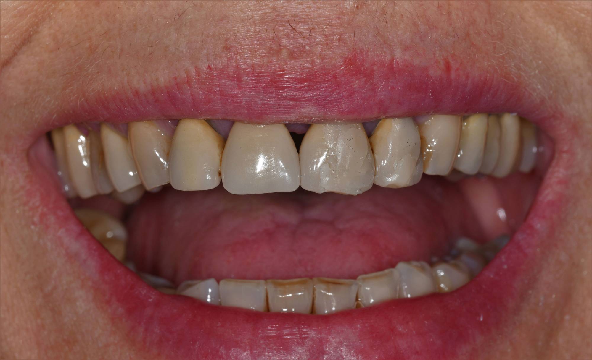 studio-dentistico-ballestrasse-besana-brianza-caso-clinico-52.1