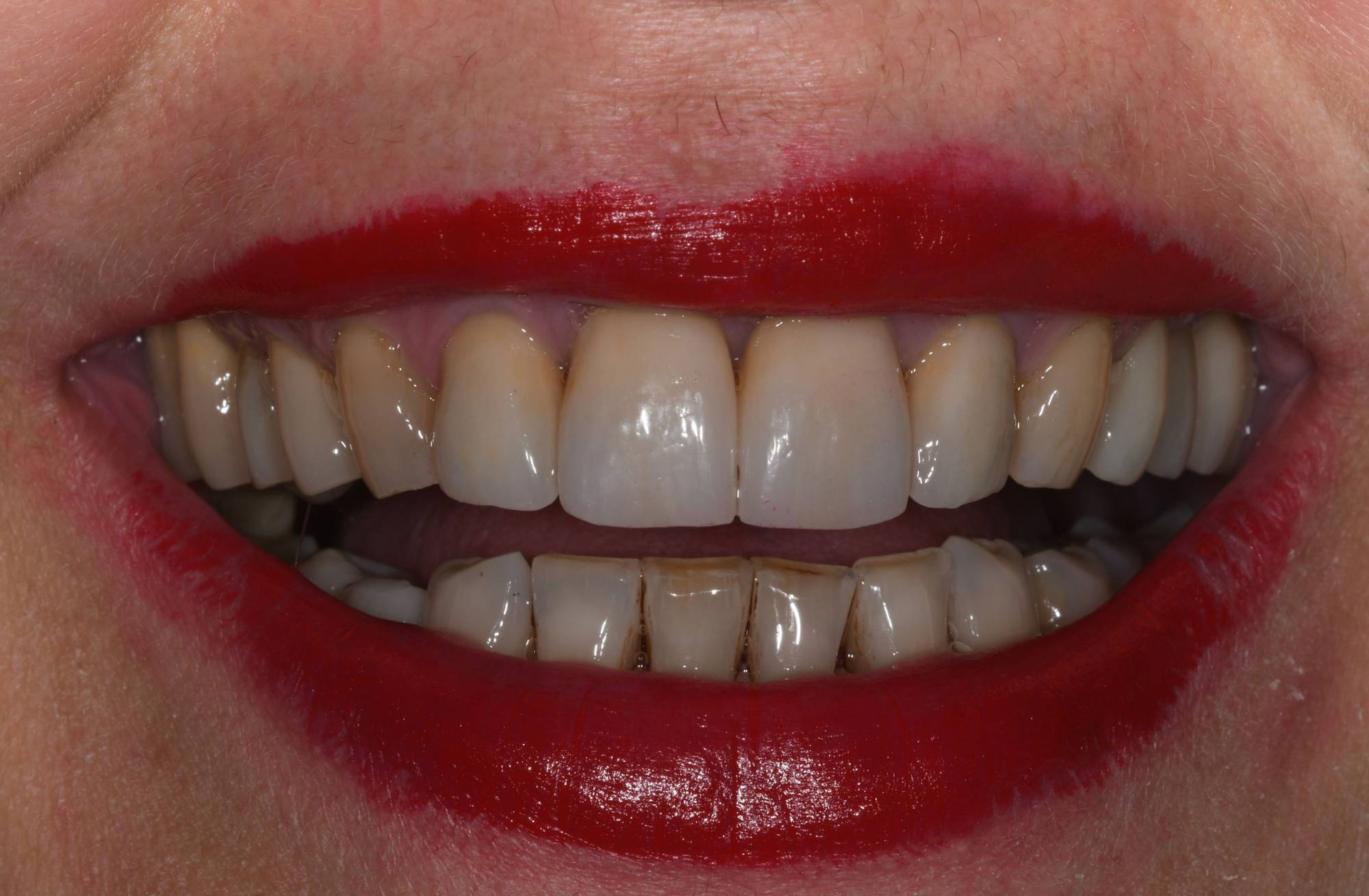 studio-dentistico-ballestrasse-besana-brianza-caso-clinico-52.2