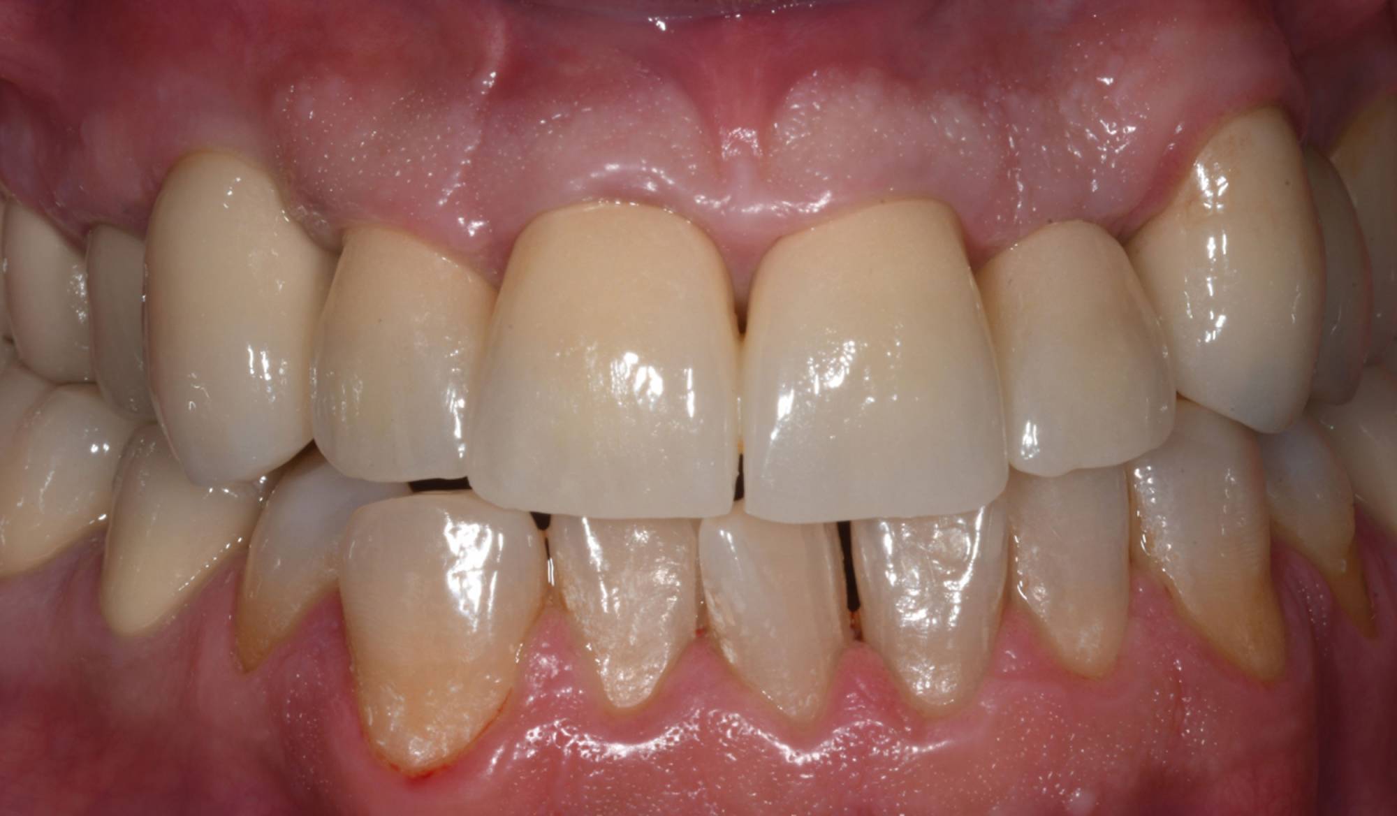 studio-dentistico-ballestrasse-besana-brianza-caso-clinico-48.2