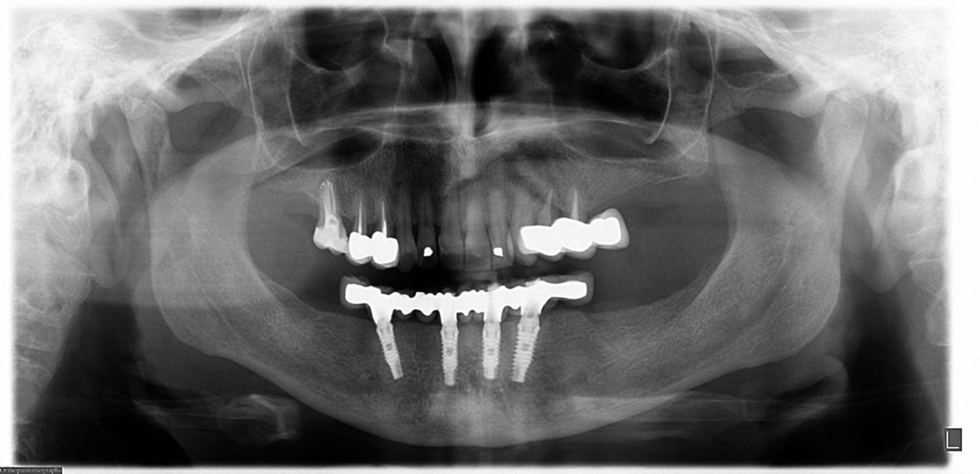 studio-dentistico-ballestrasse-besana-brianza-caso-clinico-9.4