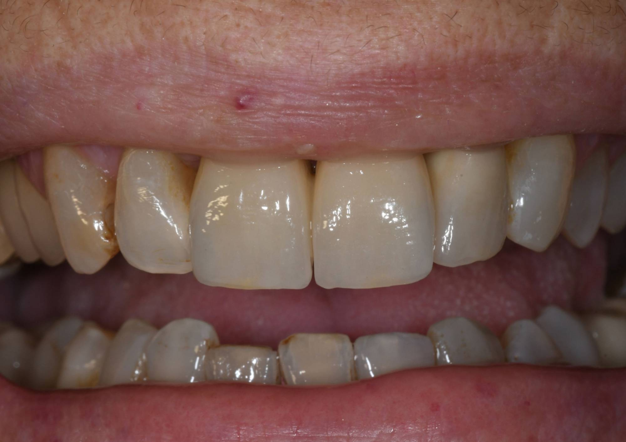 studio-dentistico-ballestrasse-besana-brianza-caso-clinico-49.2