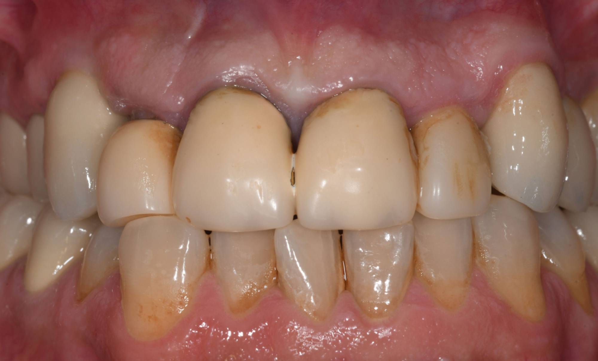 studio-dentistico-ballestrasse-besana-brianza-caso-clinico-48.1
