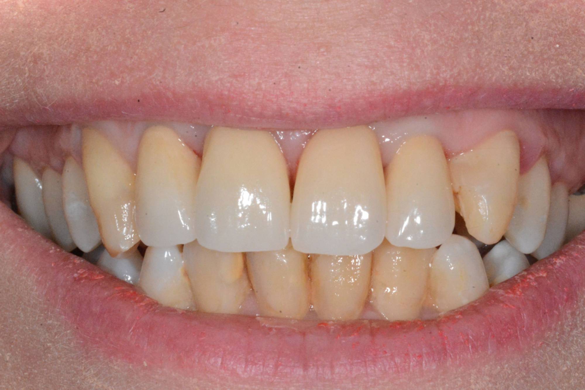 studio-dentistico-ballestrasse-besana-brianza-caso-clinico-45.2