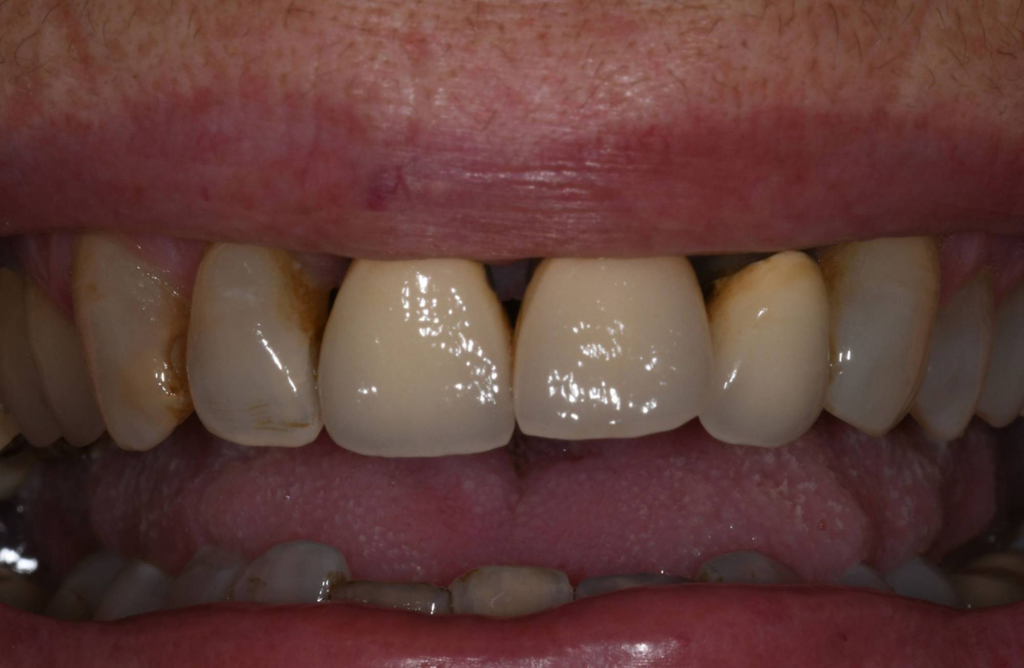 studio-dentistico-ballestrasse-besana-brianza-caso-clinico-49.1