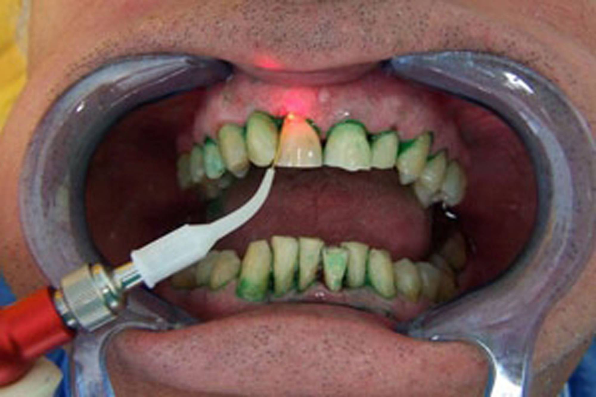 studio-dentistico-ballestrasse-besana-brianza-caso-clinico-21.1