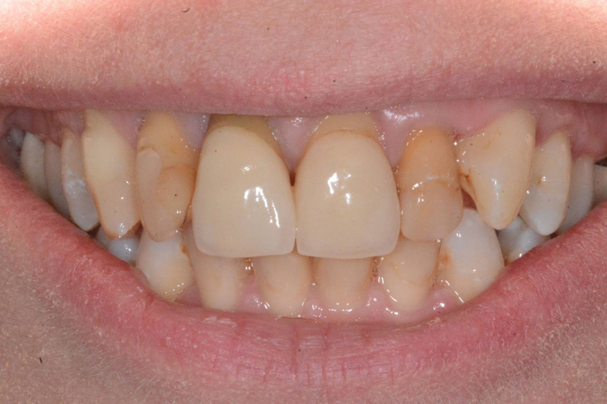 studio-dentistico-ballestrasse-besana-brianza-caso-clinico-45.1