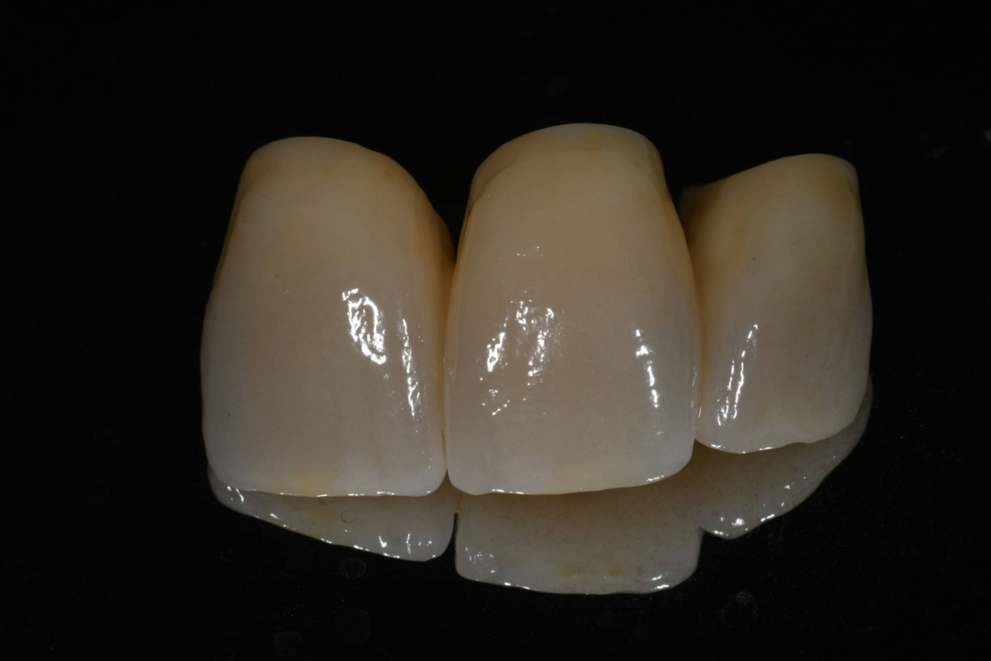 studio-dentistico-ballestrasse-besana-brianza-caso-clinico-49.3