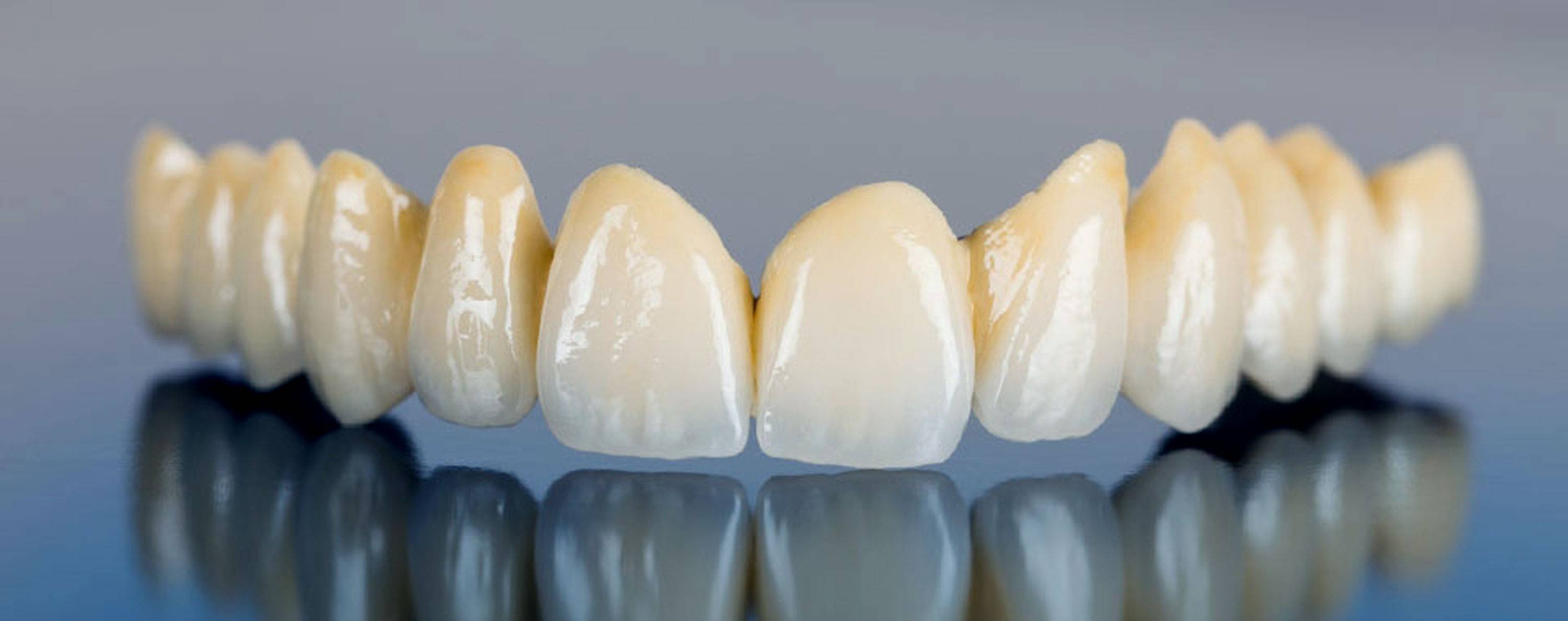 studio-dentistico-ballestrasse-besana-brianza-corone-metal-free