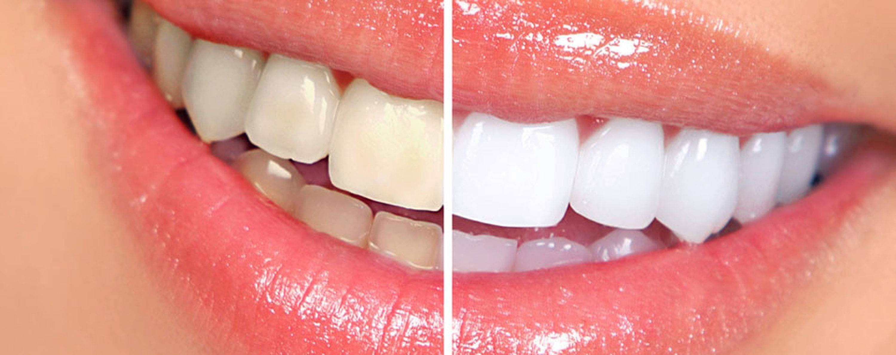 studio-dentistico-ballestrasse-besana-brianza-sbiancamento